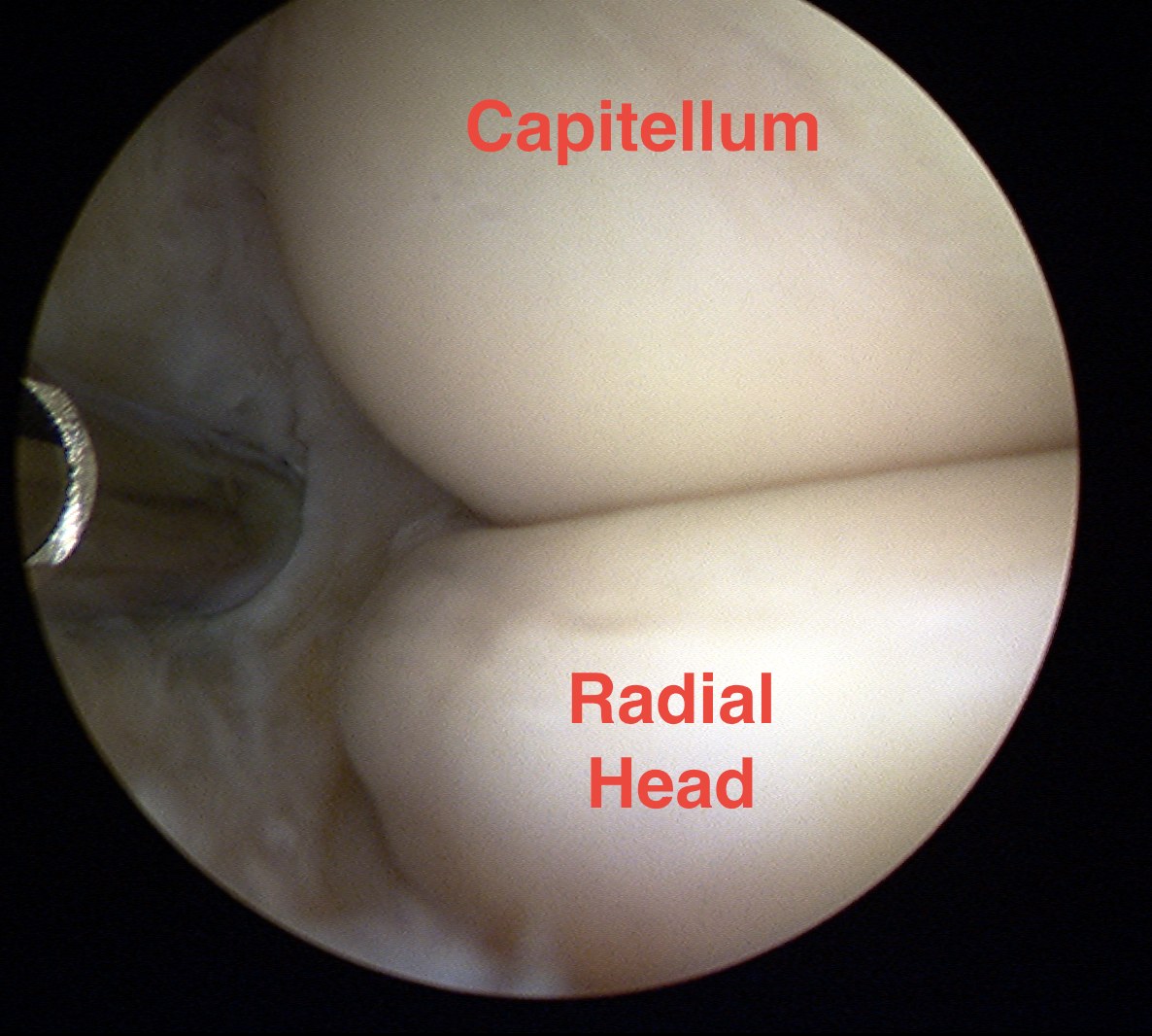 Elbow Arthroscopy Anterolateral